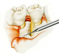 歯肉の剥離